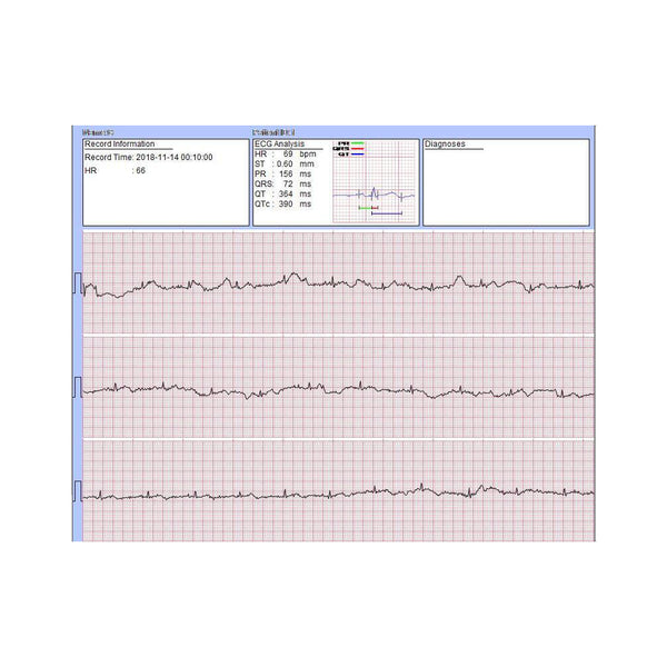 FL20 Handheld Portable ECG Monitor